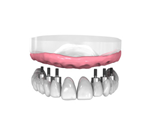 Les bridges sur implant dentaire